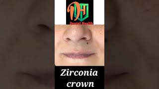 zirconia crown before and After short viral dental [upl. by Alhahs]