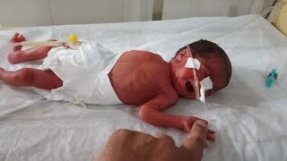 7 months pregnancy baby delivered premature baby born premature baby delivery [upl. by Accalia]