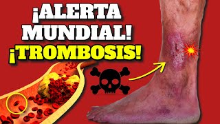 ¡ALERTA MUNDIAL SURGEN TROMBOSIS COÁGULOS y EMBOLIA SIGNOS DE ALARMA y COMO PREVENIR TROMBOS [upl. by Yddeg]