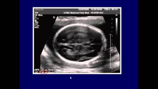 fetal biometry pptx [upl. by Annerol]