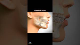 Corrective Jaw Surgery  Orthognathic Surgery  animation shorts [upl. by Alleinad]