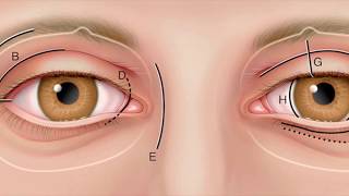 Lateral Orbitotomy avoided by performing Inferior Transconjunctival Orbitomy by Dr Akshay Nair [upl. by Tezil]