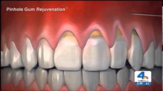 Reverse Receding Gums  Pinhole Gum Rejuvenation [upl. by Dnilazor]