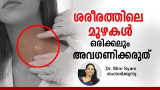 ശരീരത്തിലെ മുഴകൾ ഒരിക്കലും അവ​ഗണിക്കരുത്  Tumors  Malayalam Health Tips  Asia Live TV [upl. by Desma]