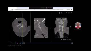 Vertebral Artery Dissection [upl. by Aelaza]