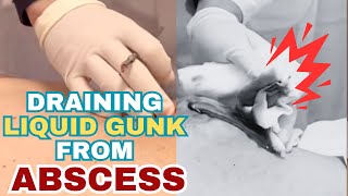 Squeezing Putrid Pus Gunk from Huge Abscess [upl. by Christianity]