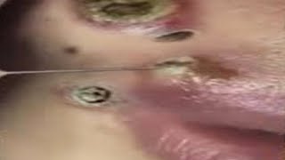 Big Cystic Acne Blackheads Extraction Blackheads amp Milia Whiteheads Removal Pimple Popping 011 [upl. by Normandy]