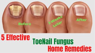 5 Natural Remedies For Toenail Fungus – Toenail Fungus Treatment At Home [upl. by Urian651]