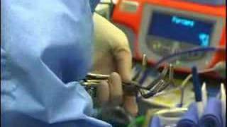 Laparoscopic Nephrectomy [upl. by Robison]