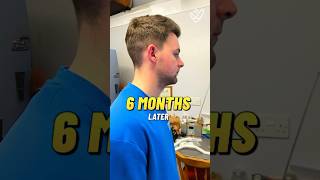 2100 Grafts Hair Transplant 🔥 Before  After hairtransplant transformation trendingshorts [upl. by Sharyl]