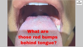 What are Red bumps behind Tongue  Taste Buds How to keep them clean and healthy [upl. by Christoper]