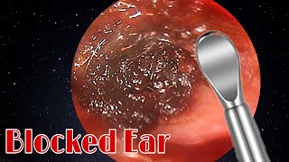 BIGGEST Ear Wax Difficult Removal  EP3  Doctor Anh [upl. by Aihsemaj627]