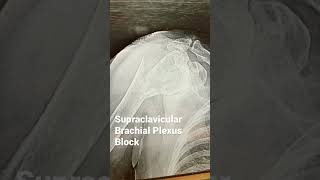 Supraclavicular Brachial Plexus Block nerveblock [upl. by Lodnar]