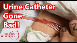 Urinary CATHETER PROBLEMS  Heart Surgery Gone Bad amp Problem with Catheter [upl. by Munmro846]