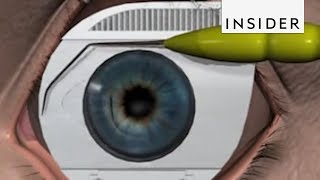 How LASIK Eye Surgery Is Performed [upl. by Marvel]