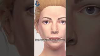 HIFU SKIN antiaging procedure non invasive and lasting results swaroop clinic yeolesskin clinic [upl. by Turino312]