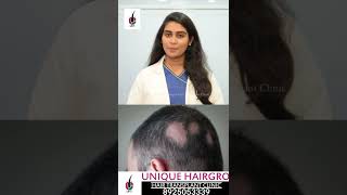 Day1 Alopecia Areata Tamil  Causes Diagnosis amp Hair Regrowth Treatments [upl. by Garold847]