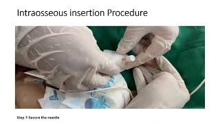 Intraosseous Insertion  Competency PE 2417  Pediatrics [upl. by Nuawad535]