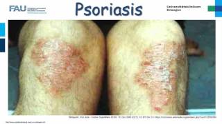 Dermatologie ─ Psoriasis [upl. by Boudreaux]