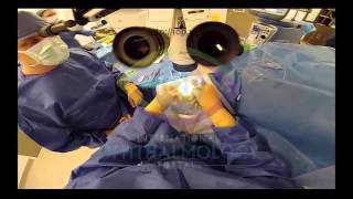 Endothelial Keratoplasty Part 4 Preview [upl. by Goodkin]