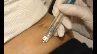 How correctly use multidose GONAL  F injection [upl. by Ardnasirhc]