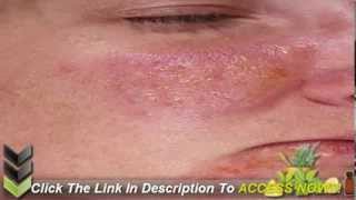 How to Cure Psoriasis Fast [upl. by Hamlani]