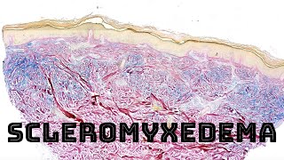 Scleromyxedema with colloidal iron stain pathology dermpath dermatology [upl. by Yatnuahc]