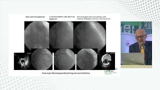 Calcium Debulking Strategy using Rotational Atherectomy by Dr Imad Sheiban [upl. by Llehsam258]