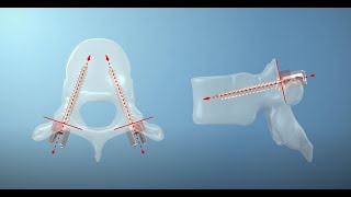 Free hand technique for pedicle screw [upl. by Volding]