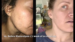 113 HOURS of electrolysis permanent facial hair removal before amp now PCOShirsutismbearded women [upl. by Hoeve75]