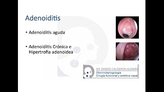 4 Adenoiditis [upl. by Fransen488]