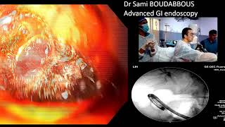 ERCP for severe acute cholangitis [upl. by Norm]