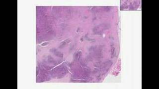 Histopathology Lymph nodeNodular sclerosis Hodgkin lymphom [upl. by Ahrendt]