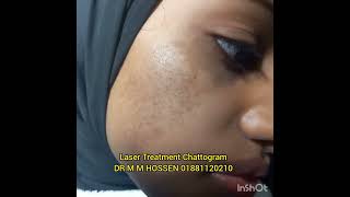 জন্মদাগ Birthmark Nevus of ota রোগী রিভিউ patient review 01881120210 [upl. by Lightfoot80]