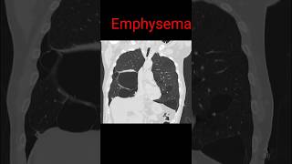 Emphysema  Lung disease emphysema shorts radiology radiologyjunction [upl. by Nima]