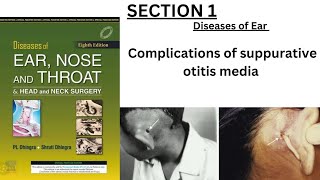 chap 12 pt1 Complications of supparative otitis media ENT dhingra complete chapter quick review [upl. by Eart]