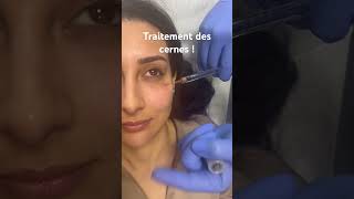 Traitement des cernes par acidehyaluronique raspaldo regard medecineesthetique [upl. by Akerahs]