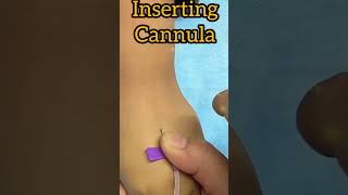 Inserting iv cannula musictrending nursing cannula [upl. by Marsiella]