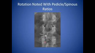 How to Read a Lumbar Spine Xray  Reading Standing Spine Xray [upl. by Hcelemile]