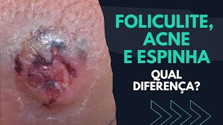 FOLICULITE Acne Espinha QUAL DIFERENÇA  SAIBA [upl. by Atsejam703]