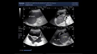 Ultrasound Video showing Hepatic cirrhosis splenomegaly ascites GB stone and pleural effusion [upl. by Llorrad]