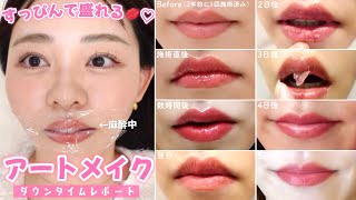 【アートメイクですっぴんも可愛く💋】施術直後からダウンタイムが終わるまで全部見せ🫣値段＆クリニックも公開！ [upl. by Nrubliw]