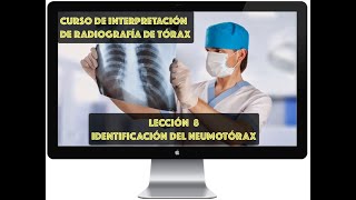 CURSO DE INTERPRETACIÓN DE RADIOGRAFÍA DE TÓRAX IDENTIFICACIÓN DEL NEUMOTÓRAX [upl. by Eecart]