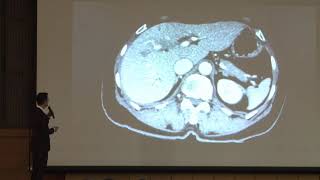 Surgical anatomy of perihilar cholangiocarcinoma [upl. by Eet]