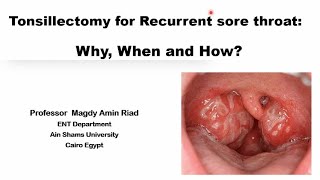 Tonsillectomy for Recurrent sore throat Why When and How [upl. by Elleiram]