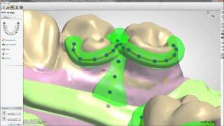 Removable Partial Dentures Design with 3Shape  Maptec KSA [upl. by Barina]