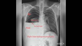 Chest X rays Part 2  Pleural effusion Hydropneumothorax Pneumothorax [upl. by Ylrbmik]