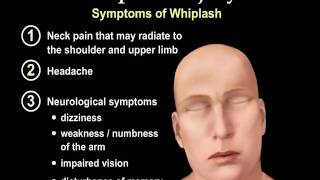 Whiplash Injury Animation  Everything You Need to Know  Dr Nabil Ebraheim MD [upl. by Yelich]