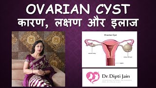 OVARIAN CYST ओवरी में गाँठ  सिस्ट HINDI Gynaecologist Dr Dipti Jain Ahmedabad [upl. by Anomas]