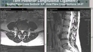 Torn Posterior Longitudinal Ligament [upl. by Fleece]